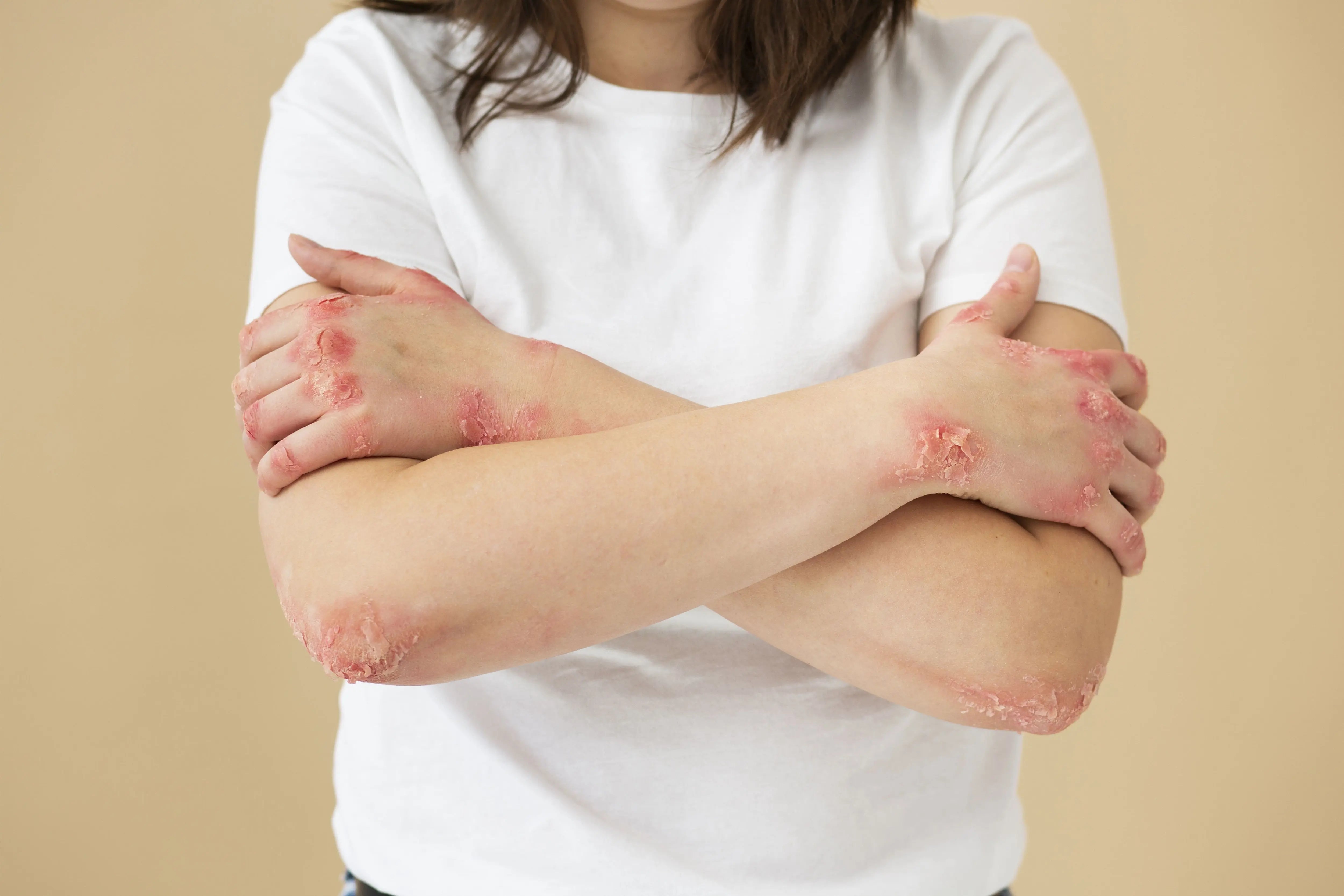 Classic Rash Differentiating Hives and Rashes: Identifying Key Distinctions ...
